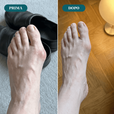 Tutore EMS per Alluce Valgo
