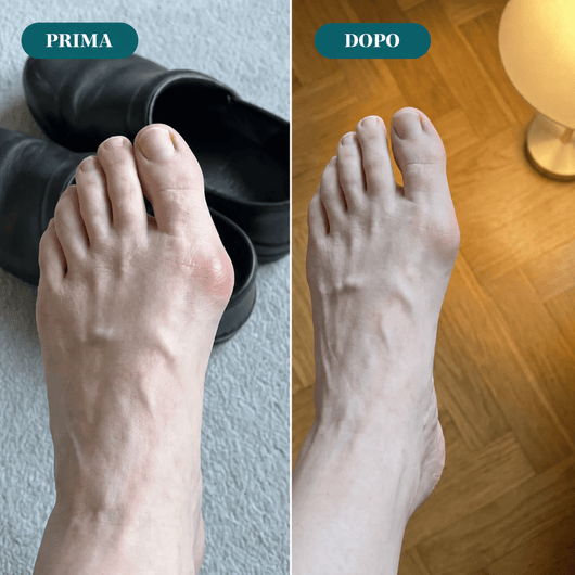 Tutore EMS per Alluce Valgo